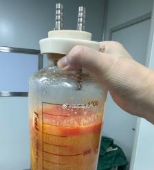 济南水动力吸脂手术要做多久？